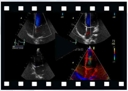 melhor sistema para laudo de ecocardiograma com imagens de ultrassom cardíaco e doppler colorido